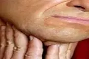 هشدار؛ گرفتگی صدا زنگ خطر ابتلا به یک سرطان
