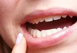 چه کنیم تا دهانمان کمتر آفت بزند؟