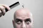 آشنایی با انواع روش های کاشت موی مدرن
