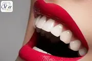 چگونه لبخندی هالیوودی داشته باشیم؟