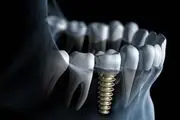  درباره ایمپلنت‌ دندان بیشتر بدانید