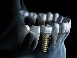  درباره ایمپلنت‌ دندان بیشتر بدانید