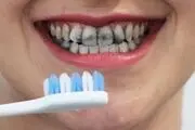 چرا دندان‌ها می‌پوسند؟