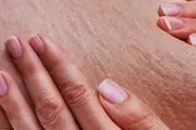 سلولیت در کمین چه کسانی است؟ راه درمان