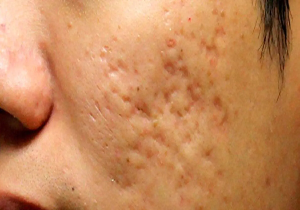 رابطه بین آکنه و رژیم غذایی چیست؟