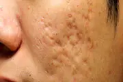 راهکار طلایی برای از بین بردن جای جوش ها
