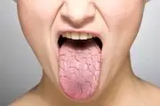 علت خشکی دهان + درمان