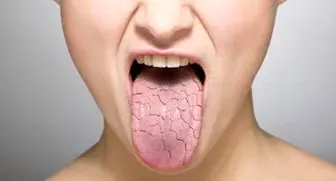 علت خشکی دهان + درمان
