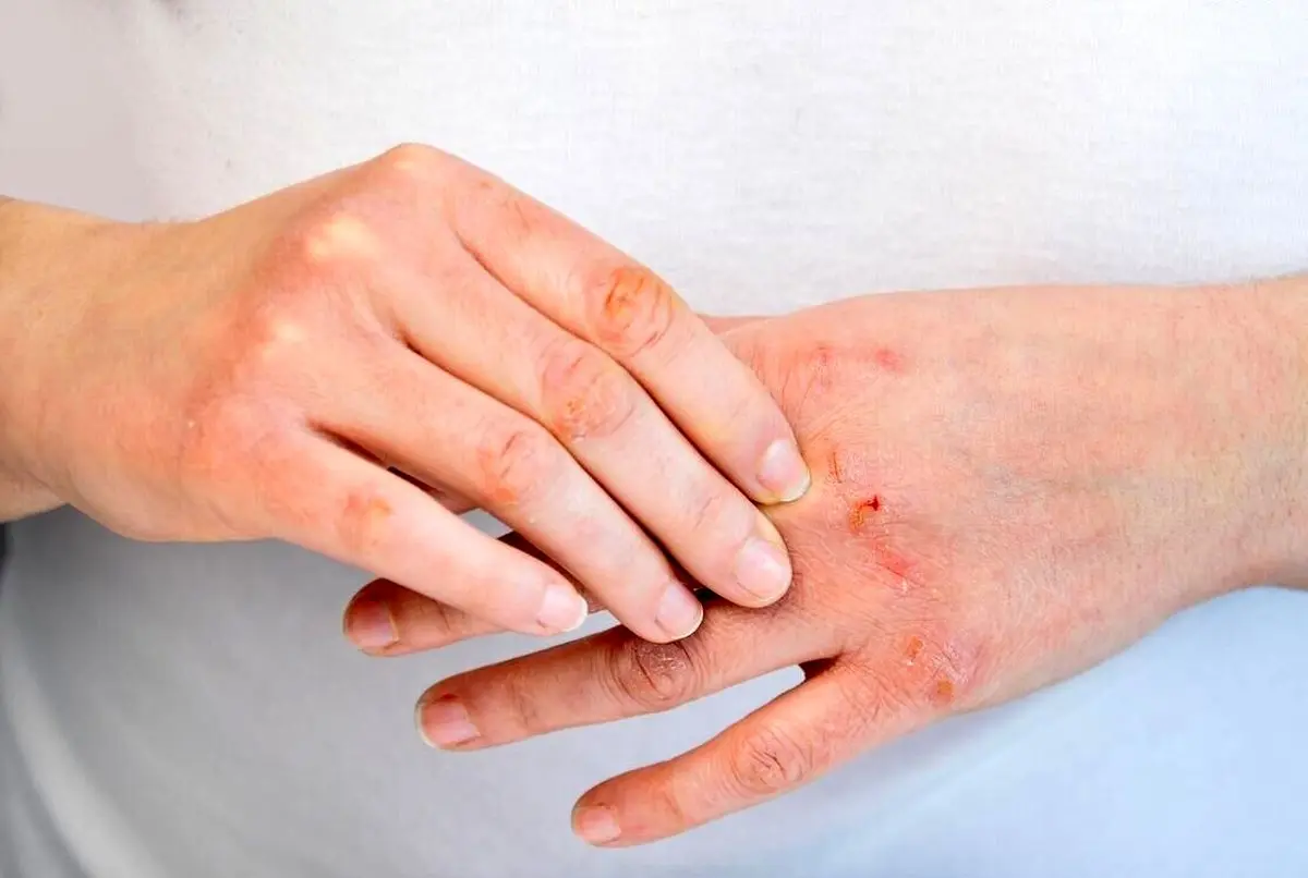 چگونه از خشکی پوست در زمستان جلوگیری کنیم؟
