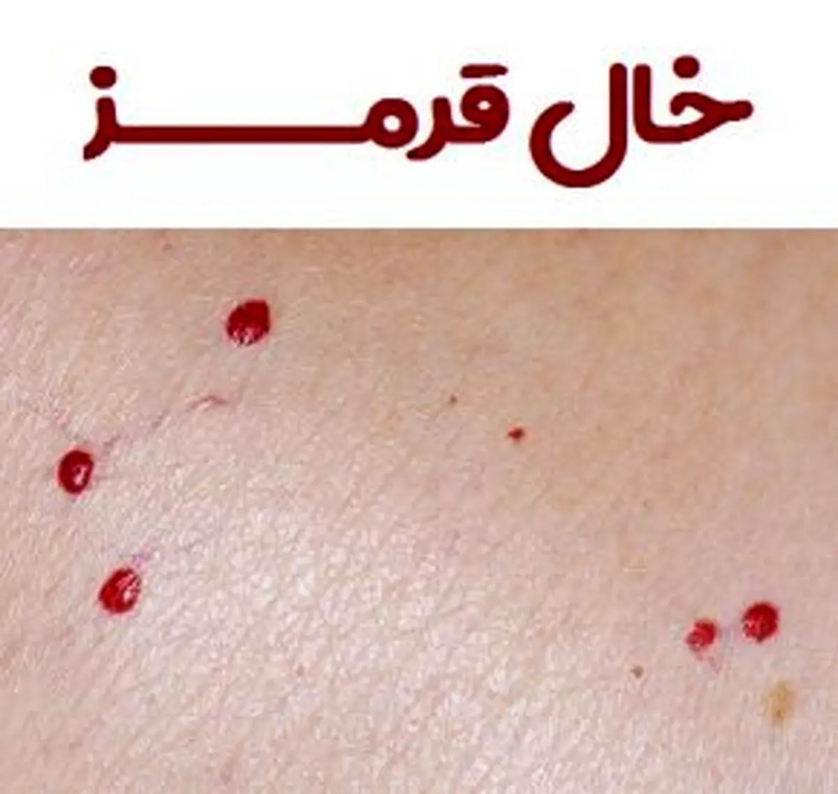 از خال‌های قرمز پوست بترسیم یا نه؟