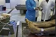 سودهای کلان پیوند غیرقانونی اعضای بدن در جیب دلالان