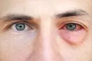 همه آنچه باید درباره کرونای چشمی بدانید