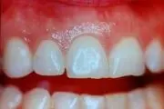 مواد غذایی که قاتل دندان‌ها هستند