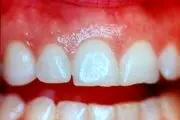 علل سایش دندانی چیست؟