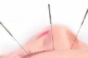 طب سوزنی در کاهش وزن موثر است

