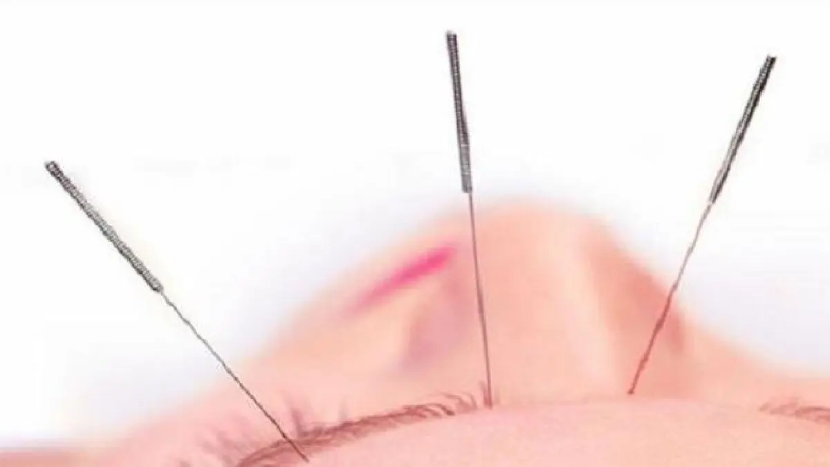 طب سوزنی در کاهش وزن موثر است
