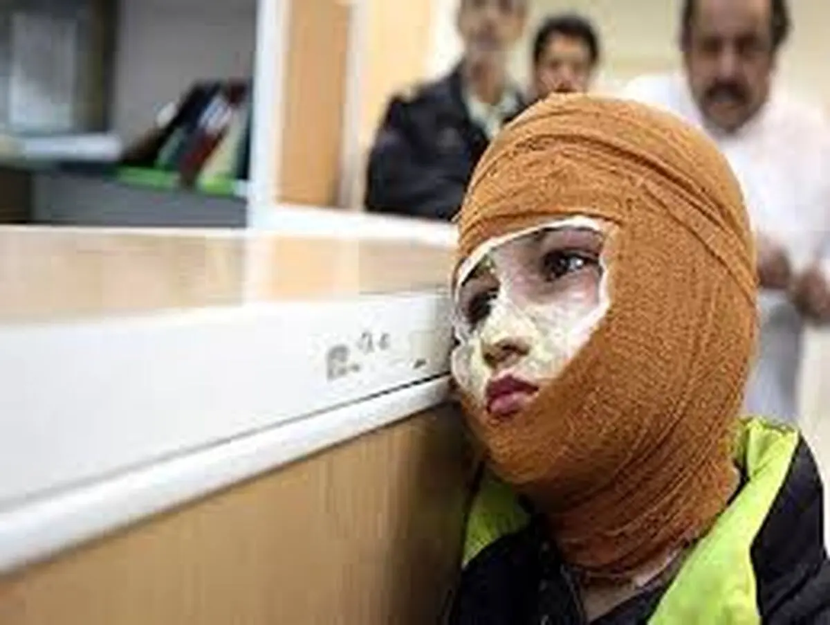 برای درمان سوختگی از آتش در چهارشنبه‌سوری چه کار کنیم؟