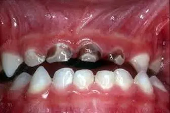 ارتباط سرطان‌های دستگاه گوارش با پوسیدگی‌ دندان