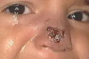 آمار ابتلا به سالک در فارس رو به کاهش است