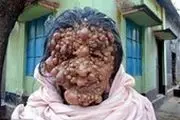 زنی با هزاران تومور روی صورتش!/ عکس