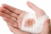 روش درمان سریع سوختگی با آب جوش 