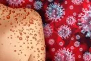 احتمال تبدیل آبله میمونی تبدیل به پاندمی!
