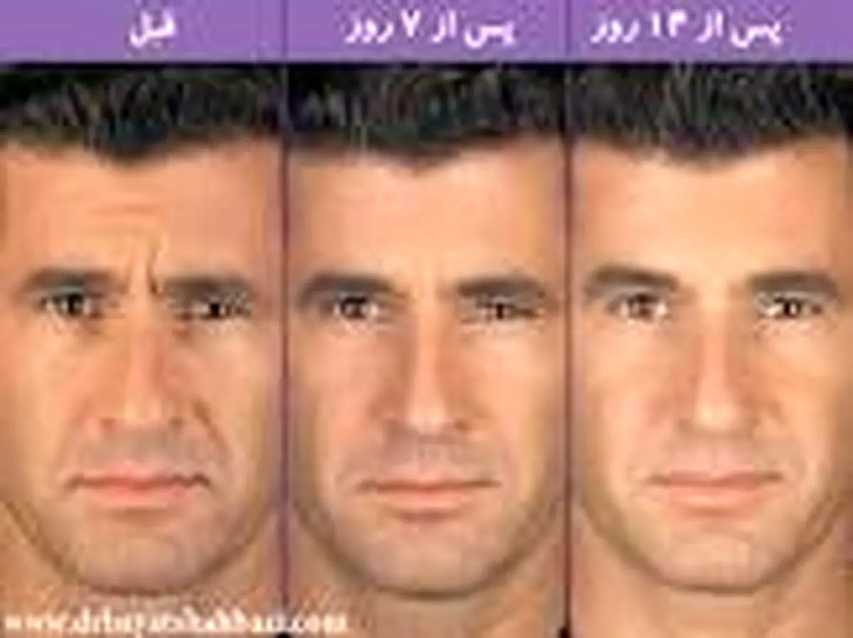 سن مناسب برای تزریق بوتاکس