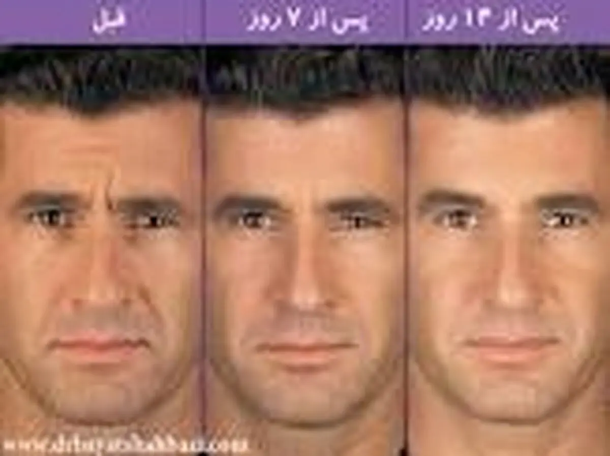 سن مناسب برای تزریق بوتاکس