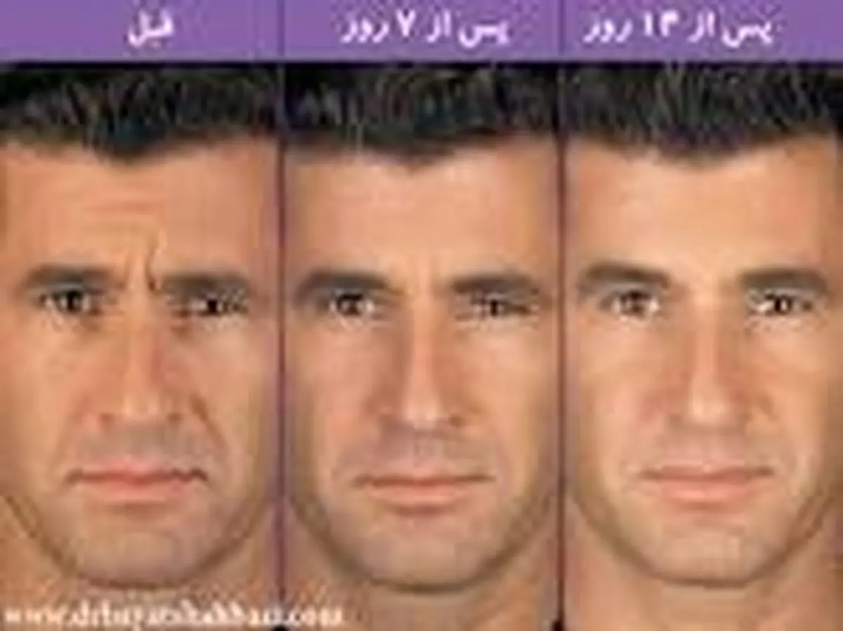 سن مناسب برای تزریق بوتاکس