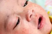 بیش از ۱۴۰ هزار قربانی سرخک در جهان
