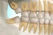 سه عامل «عفونت لثه» کدامند؟