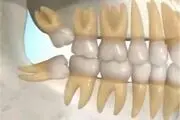 سه عامل «عفونت لثه» کدامند؟
