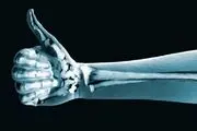 از آینده استخوان هایتان محافظت کنید
