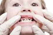میکروب دهانتان کم است یا زیاد؟