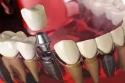 فرآیند ایمپلنت دندان چقدر است؟