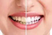 چرا دندان هایمان زرد می شود؟
