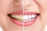 پیشگیری از پوسیدگی دندان در مناطق محروم/ عکس
