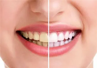 در مورد سفید کردن دندان‌ها بیشتر بدانید