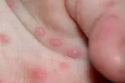 راهکار درمانی کهیر مزمن