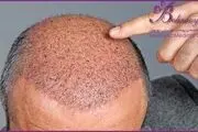 آلودگی هوا و تأثیرات آن بر ریزش مو

