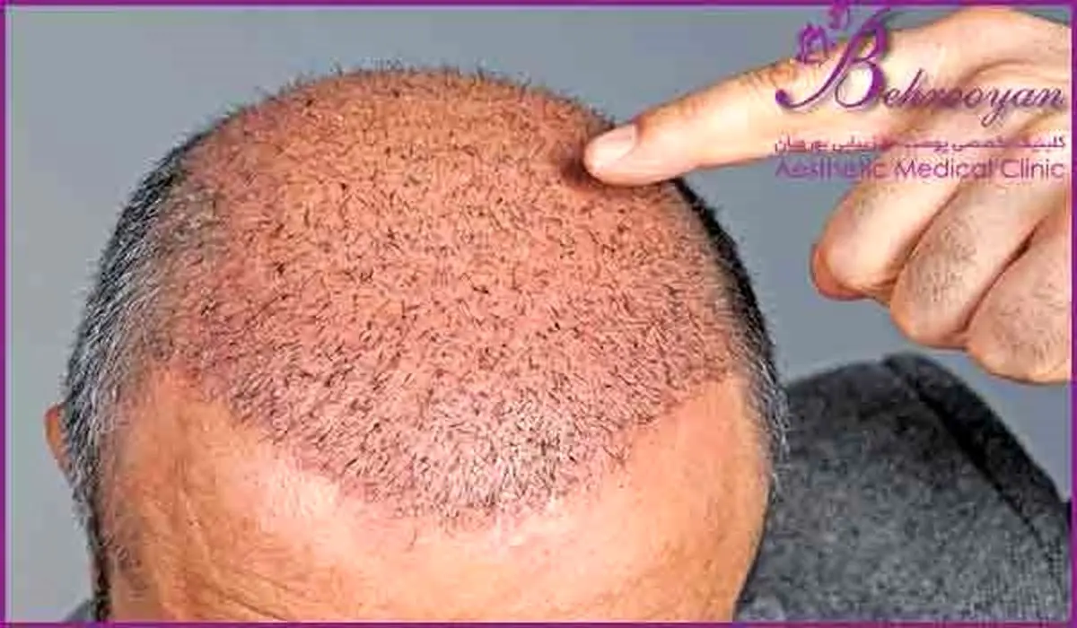 آلودگی هوا و تأثیرات آن بر ریزش مو