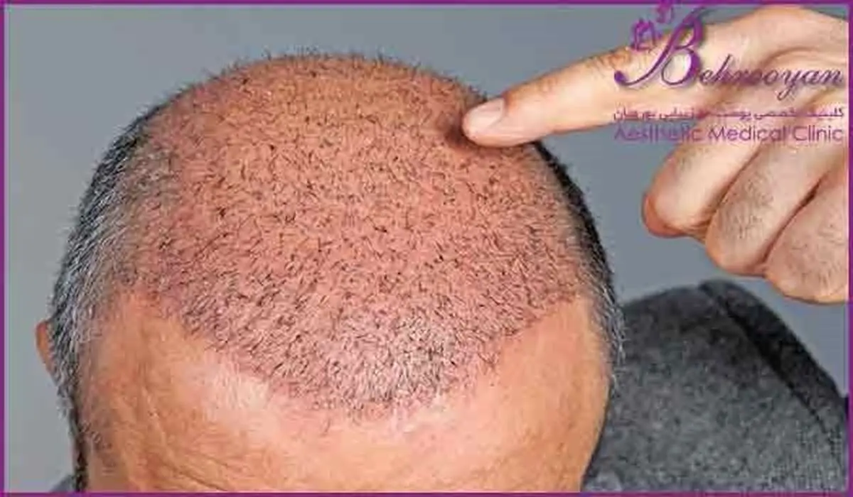 آلودگی هوا و تأثیرات آن بر ریزش مو

