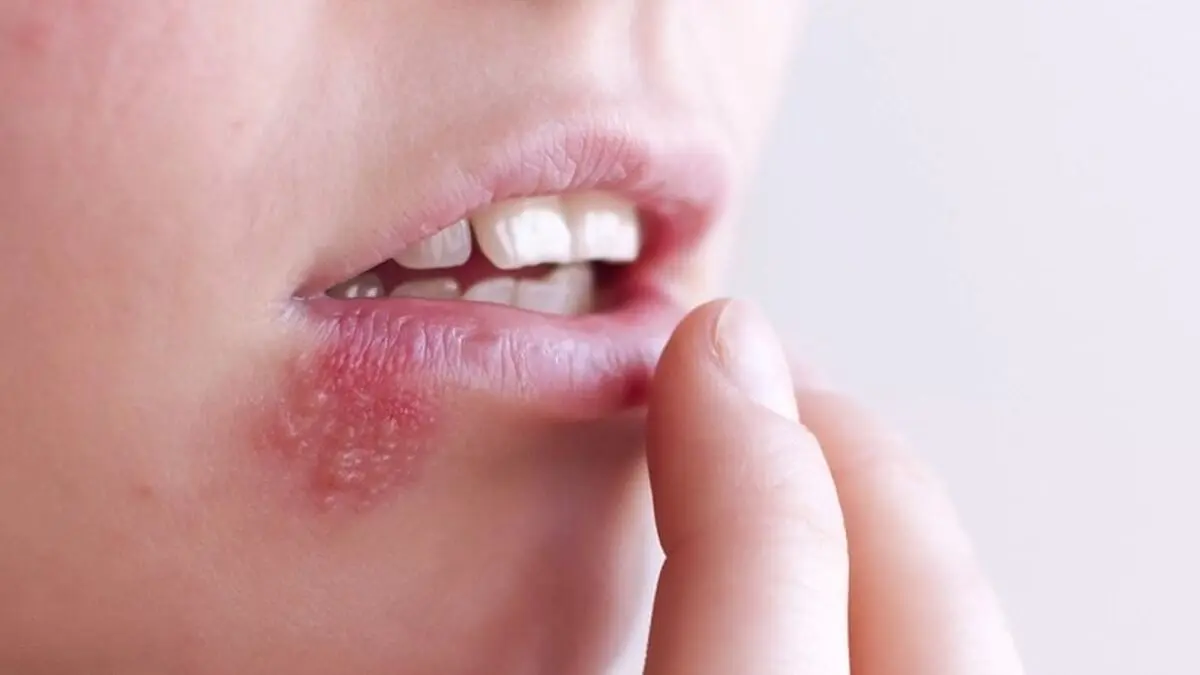 چرا تبخال می‌زنیم و چطور باید از شر آن خلاص شویم؟
