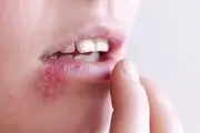 چرا تبخال می‌زنیم و چطور باید از شر آن خلاص شویم؟
