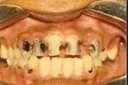 پیشنهادی ملی برای جلوگیری از پوسیدگی دندانی