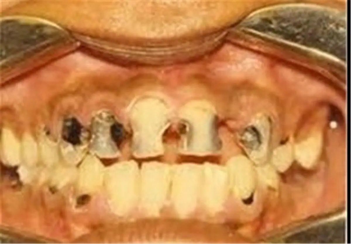 پیشنهادی ملی برای جلوگیری از پوسیدگی دندانی