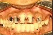 پیشنهادی ملی برای جلوگیری از پوسیدگی دندانی