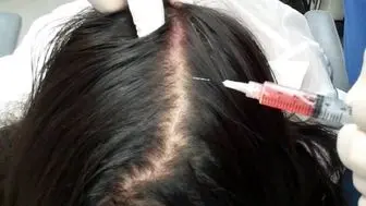 آیا ریزش مو با پلاسما قابل درمان است؟

