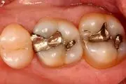 ماده پرکننده دندانی که سرطان به جانتان می‌اندازد