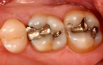 ماده پرکننده دندانی که سرطان به جانتان می‌اندازد
